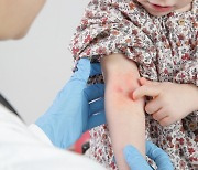 국내 연구팀, ‘아토피 피부염 치료제’ 개발 실마리 규명