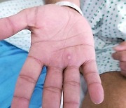 원숭이두창 환자 검사중 바늘 찔린 의료진 확진, 국내 감염 첫 사례[종합]