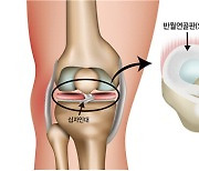 골프, 테니스, 스키 열풍 속 무릎관절 지키려면?