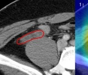 ‘정확도 89.4%’… CT영상 판독 충수염 자동 진단 AI 모델 개발