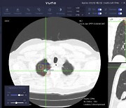 뷰노 "흉부 CT 판독 AI, 식약처 혁신의료기기 지정"