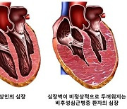 서울대병원 연구진, 비후성심근증 정신질환 연관성 규명