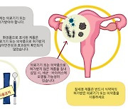 외음부 세정제, 질 안에 쓴다?