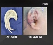 '소이증·백반증' 어린이 수술법 진화 "마음마저 낫게 해"