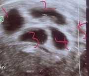 다섯쌍둥이 母 "선택적 유산 생각했는데..심장소리 들으니 못하겠더라"[Oh!쎈 포인트]