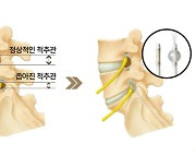 허리 통증, 디스크와 척추관협착증 차이는?