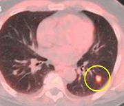 이제 조직검사 없이도 '암 진단' 한다