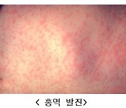 3년만에 해외유입 홍역환자 발생