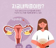 "자궁내막증, 맞춤형 표적치료 가능해진다"