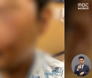 눈 마주치자 너클 손에 낀 채 가격한 10대…"피해자 실명 위기"