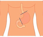 위 점막이 장 점막으로 변하는 ‘장상피화생’, 위암 발생률 10배 높인다