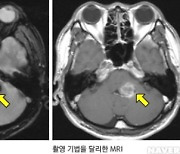 '가족성 해면상혈관종', 나이 많을수록 증상 더 나빠진다