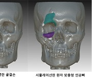 안면골 및 두개골 결손, 3D프린터 통한 인공 뼈로 신 치료길 열려