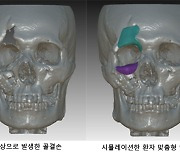 부서진 안면골·두개골, 3D 프린터로 되살린다
