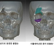 사고로 푹 꺼진 얼굴… 3D 프린터로 '맞춤 치료' 가능해졌다