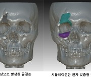 "3D프린터 활용한 맞춤 인공 뼈로 얼굴 재건 가능해져"