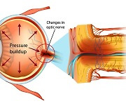 녹내장 환자의 77%...안압 정상인데도 녹내장 걸려, 왜? [눈+사람]