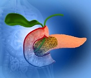 췌장암 조기 발견, 뜻밖의 진단법....상용화는 언제?