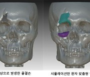 안면 골절 환자 위한 맞춤 인공뼈 3D프린터로 만든다