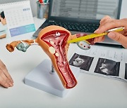 [건강톡톡] 가임기 여성 3명 중 1명에게 있는 '자궁근종', 증상과 치료는?