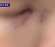 “욱해서 한대 때려” 중학생 코뼈 부러뜨린 학원 강사