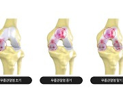한국인들이 ‘암’ 다음으로 걱정하는 질병은?, '관절염'