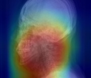 인공지능 기반 X-ray 분석으로 수면무호흡증 진단