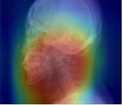 엑스레이로 수면무호흡증 진단… 국내 연구진 개발