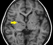 뇌혈관질환 ‘모야모야병 환자, ‘스타틴’ 복용 시 사망 위험 26% 감소