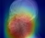 [건강소식] 인공지능 기반 X-ray 분석으로 ‘수면무호흡증’ 진단 외
