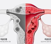 비슷한 듯 서로 다른 ‘자궁근종’과 ‘자궁선근증’