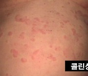 [한동하의 건강e메일] 계절 가리지 않는 두드러기