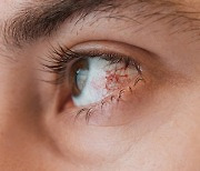 [건강톡톡] 충혈된 눈, 어떤 안약이 좋을까? '토끼눈' 관리법!