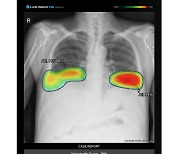 “AI영상분석 솔루션 활용했더니 폐 결절 검출률 증가”