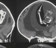 1살 아이 두개골 안에 '쌍둥이 태아'가…의료진 충격