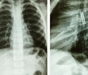 “세달 째 기침을”… 폐에서 손가락만한 ‘이것’ 발견
