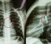 "석 달째 기침"…5세 아이 폐 엑스레이 찍었다가 '기겁'