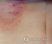"레브리키주맙, 아토피 피부염 치료 효과 확인"