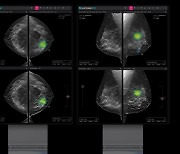 루닛 "3차원 유방암 검진 AI 솔루션, 이달 말 유럽 판매"