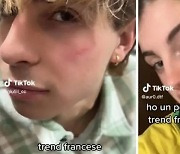 ‘얼굴 흉터 만들기’ 챌린지 유행…이탈리아 정부, 틱톡 조사
