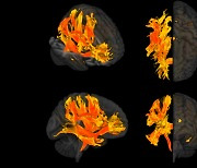 고혈압이 망가뜨리는 뇌 부위 찾았다…3만명 MRI 영상 분석