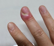 손톱 거스러미 뜯다가… 치명적인 패혈증까지?