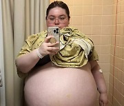 "아이 10명 임신한 느낌"…47kg '난소낭종' 제거한 20대 여성