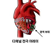 부정맥 치료 패러다임 바꾼다… 전기 충격 없는 ‘다채널 전기 자극 어레이’ 개발