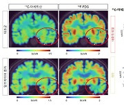 IBS, 뇌 속 반응성 별세포와 신경세포 영상화... 치매 조기 진단한다