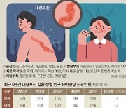 ‘통증의 왕’ 대상포진… 붉은 반점 발견 땐 72시간 골든타임 지켜요