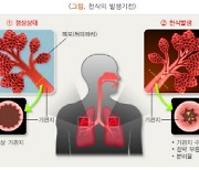 기침 오래 하면 무조건 천식?..질병청 천식 정보안내서 발간