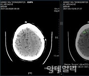 SK C&C, 뇌출혈 진단 돕는 'AI솔루션' 효과 국제 학술지 실렸다