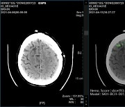 SK(주) C&C, 딥러닝 뇌출혈 자동 탐지 알고리즘 논문 게제