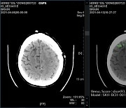 SK C&C 개발 뇌출혈 진단 보조 AI 효과 입증 논문, 국제 학술지 실려